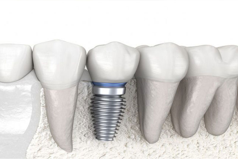 Could Dental Implants Solve Your Smile Situation?